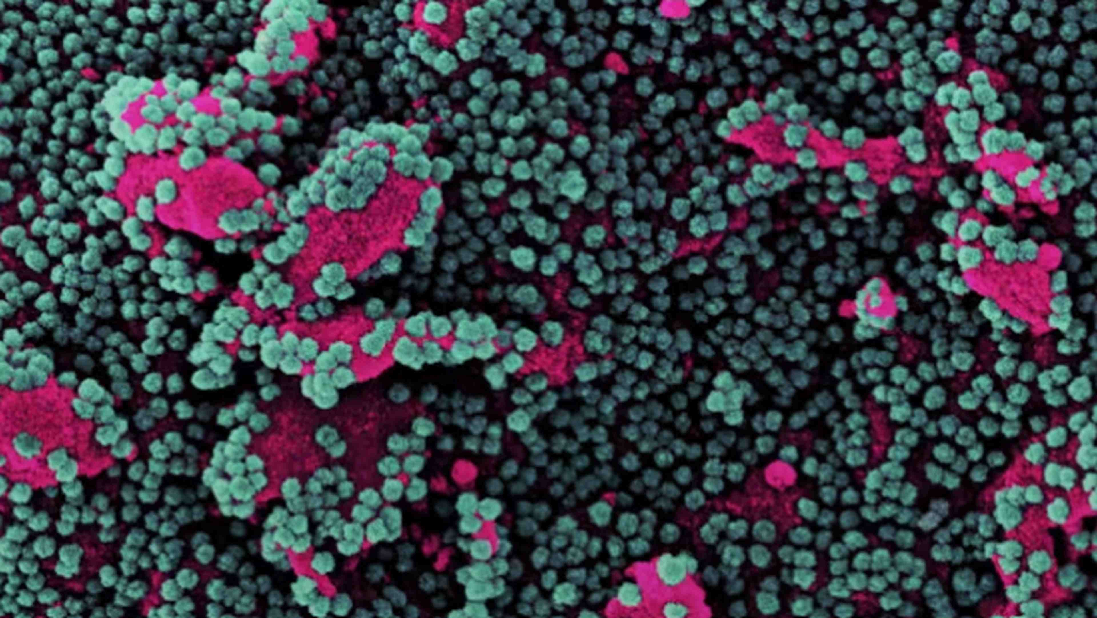 Micrographie électronique à balayage colorisée d'une cellule (rose) infectée par des particules du virus SARS-CoV-2 (vert et violet), isolée à partir d'un échantillon de patient